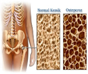 Osteoporoz hakkında