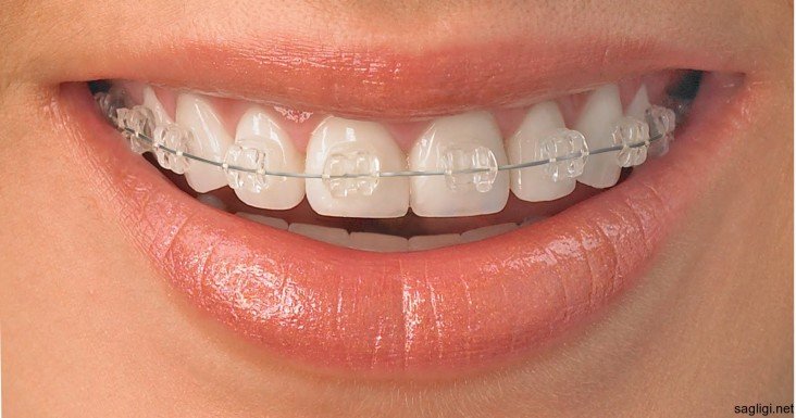 Ortodonti; kişi ortodontik bozukluk olduğunu ilk ne zaman anlar?