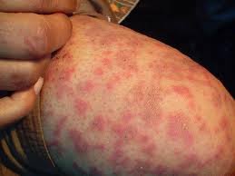 Biorezonans metodu ile  alerji tedavisi