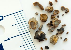 Böbrek ve üreter taşları