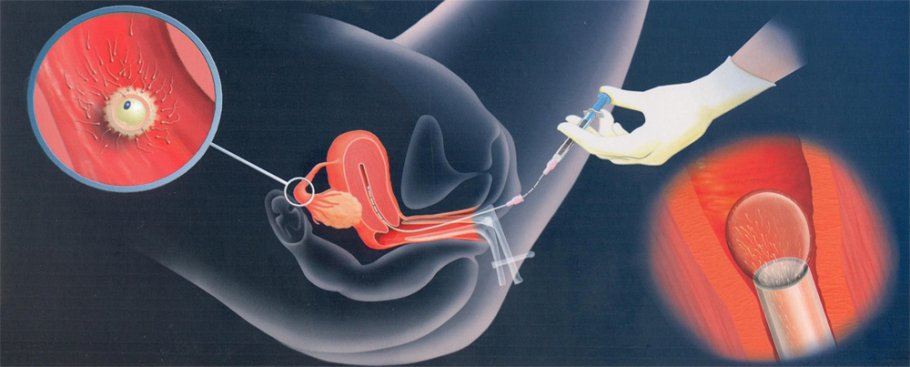 İntra uterin inseminasyon (aşılama)
