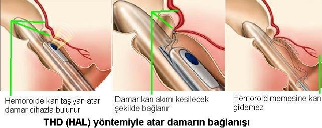 Hemoroid hastalığı ve hemoroid arter ligasyonu  (ağrısız (kesme işlemi olmadan ) kanamasız tedavi  )