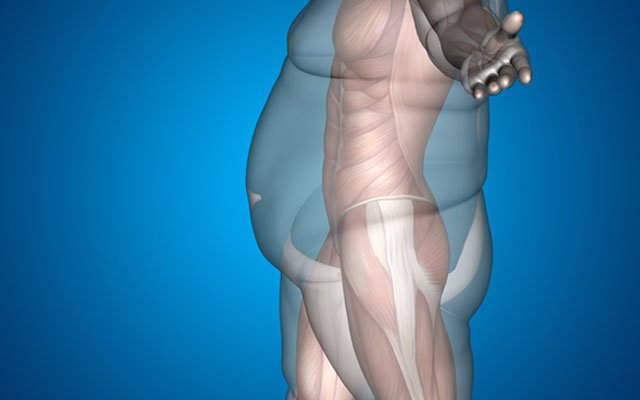 Obezite sonuçları ve obezite cerrahisinin faydaları: gastrik bypass (mide küçültme) ve sleeve gastrektomi (tüp mide)