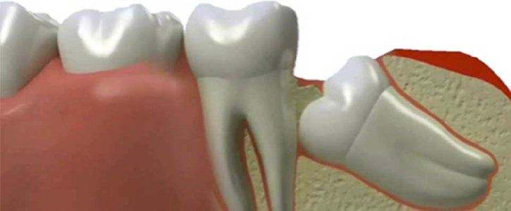 20 yaş dişleri neden çekilir , çekim sonrası neler yapılmalıdır