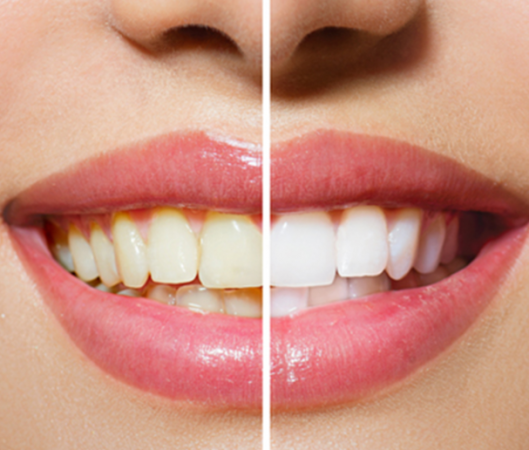 Diş beyazlatma ile ilgili sıkça sorulan sorular