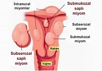Miyomlar ve infertilite