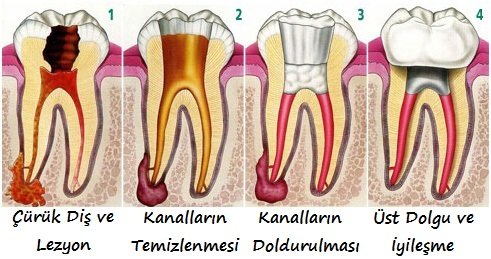 İnatçı enfeksiyonlar kanal tedavisi ve apikal rezeksiyon