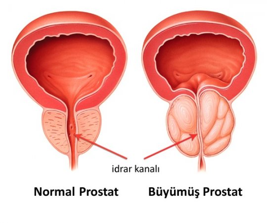 Bph (iyi huylu prostat büyümesi)