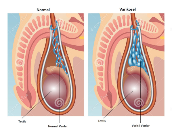 Varikosel nedir? tanısı nasıl konulur? tedavisi nedir?