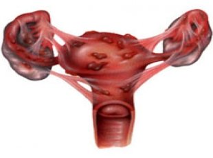 Çikolata kisti endometrioma sizi korkutmasın