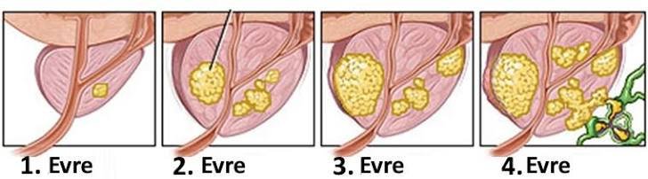 Prostatin iyi huylu büyümesi ve prostat kanseri