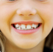 Dişlerin çapraşık çıkma sebebi nedir?