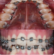 Ortodonti tedavisi (diş teli)