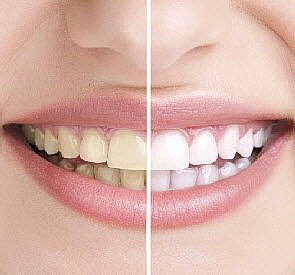 Diş beyazlatma hakkında uygulama yöntemleri