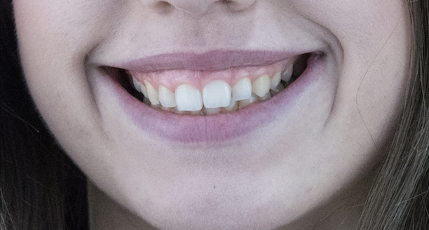 Gummy smile (dişetlerinin fazla görünmesi) ve pembe estetik tedavisi