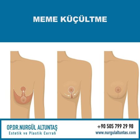 Meme küçültme ameliyat ücretleri nasıldır?