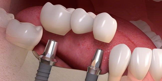 Dental implant diş tedavisinin avantajları nelerdir ?