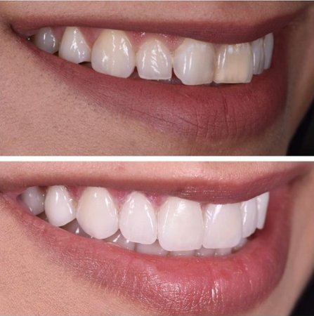 Lamina diş nedir? lamina diş kimlere uygulanır?