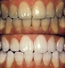 Lazerle diş beyazlatma hakkında
