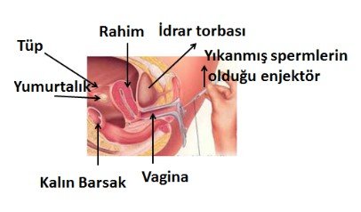 Aşılama (ıuı - ıntra uterin ınseminasyon)