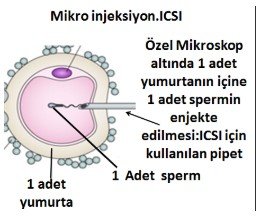 Tüp bebek (ıvf: ın vitro fertilizasyon)