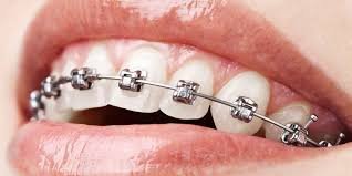Ortodonti süreci