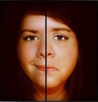 Bipolar bozukluk - iki uçlu mizaç bozukluğu