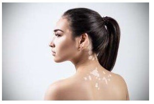 Cilt renginin beyazlaşması sonucu ortaya çıkan bir durum: vitiligo!