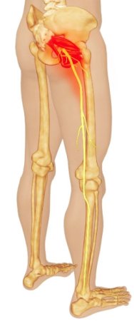 Kalça ağrısı ile giden priformis sendromu