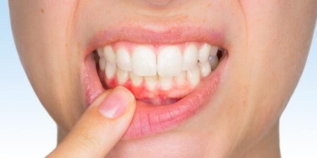 Diş eti kanamaları ve oral hijyenin hayatımızdaki önemi