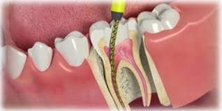 Kanal tedavisi (endodonti) nedir, nasıl yapılır?