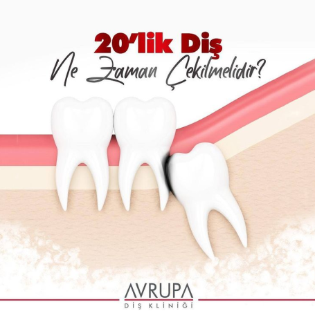 20'lik diş ne zaman çekilmelidir?