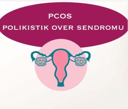 Pcos polistik over sendromu