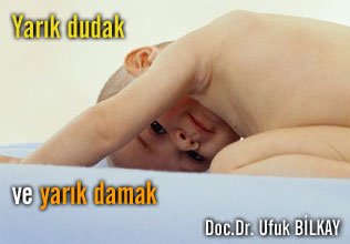 Yarık dudak ve yarık damak