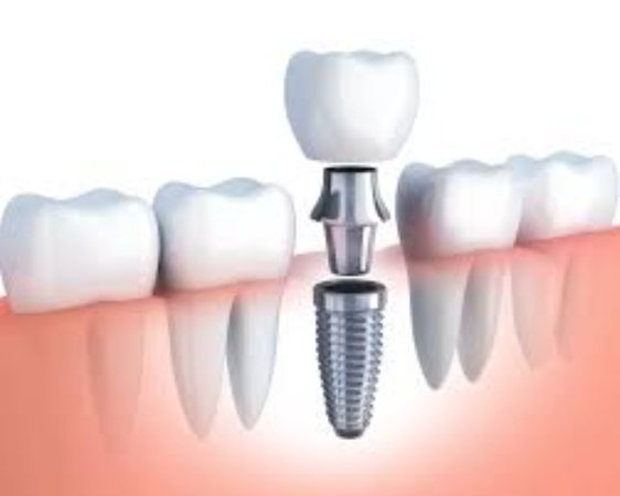 Dental implant