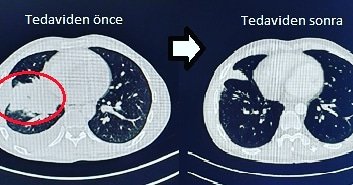 Akciğer kanserinde hedefe yönelik (akıllı ilaç) tedavi