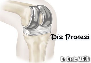 Diz protezi,