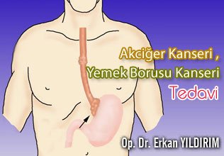 Akciğer kanseri, yemek borusu kanseri , tedavi