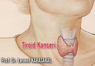 Tiroid kanseri