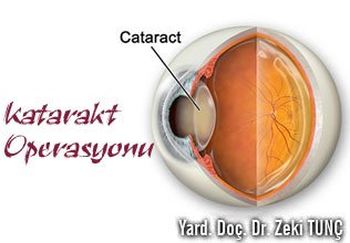 Katarakt operasyonu