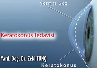 Keratokonüs tedavisi