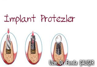 İmplant protezler