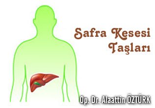Safra kesesi taşları