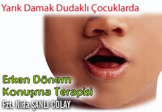 Yarık damak dudaklı çocuklarda erken dönem konuşma terapisi