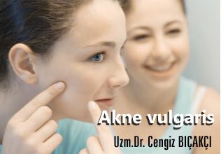 Akne vulgaris