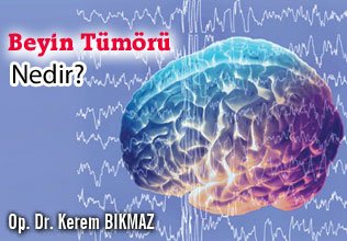 Beyin tümörü nedir?