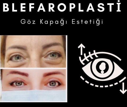 Blefaroplasti (göz kapağı estetiği)