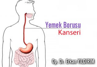 Yemek borusu kanseri hakkında merak edilenler