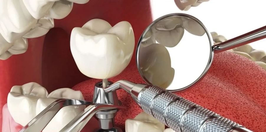 Dental implant