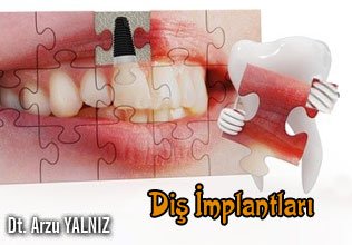 Diş implantları!